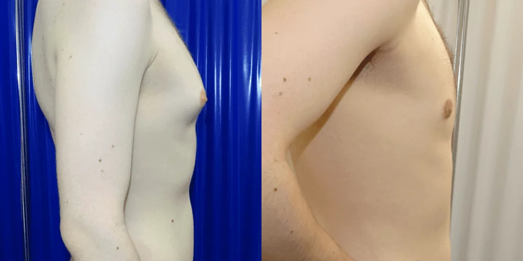 Gynecomastia Surgery London