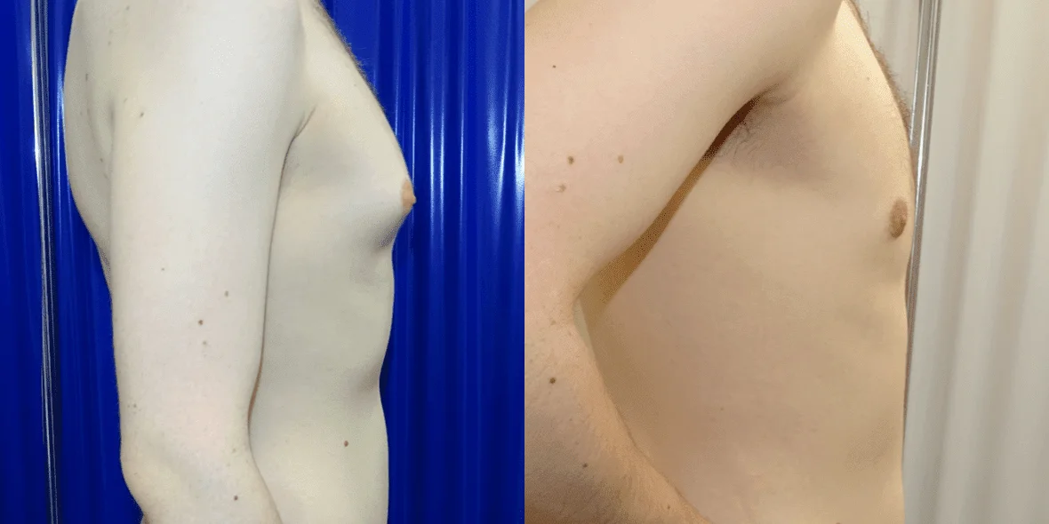 Gynecomastia Before/ After - Right Side