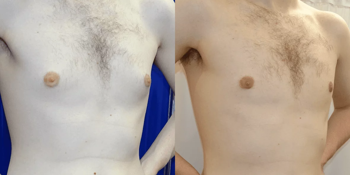 Gynecomastia Before/ After - Front View Close-Up