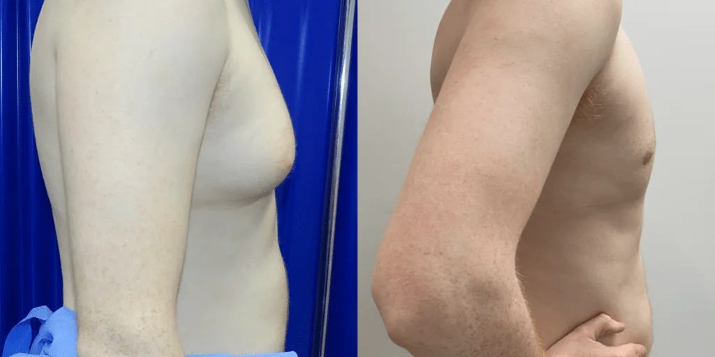 Gynecomastia Surgery London