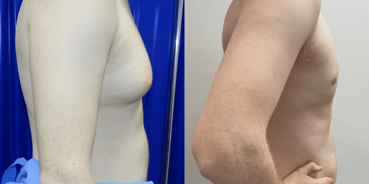 Gynecomastia Before/ After - Right Breast