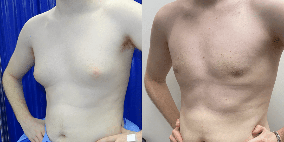 Gynecomastia Before/ After - Front View Close-Up