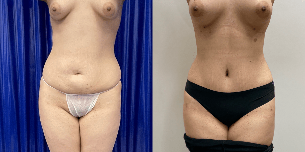 Abdominoplasty Before/ After - Fat Transfer To Breasts