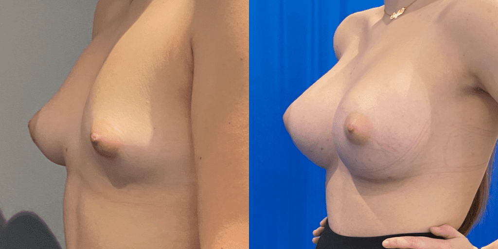 Saline Vs. Silicone Implants: What Are The Best Breast Implants?