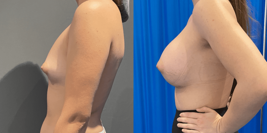 The side view of before and after breast augmentation.