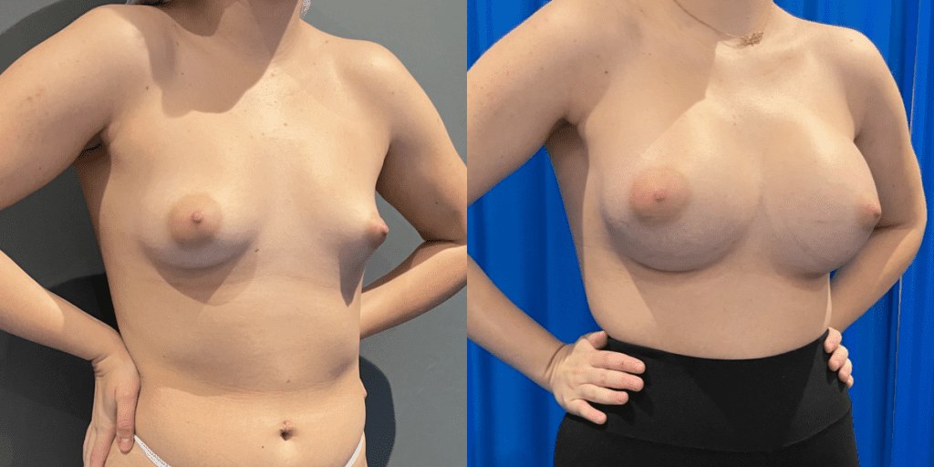 Saline Vs. Silicone Implants: What Are The Best Breast Implants?