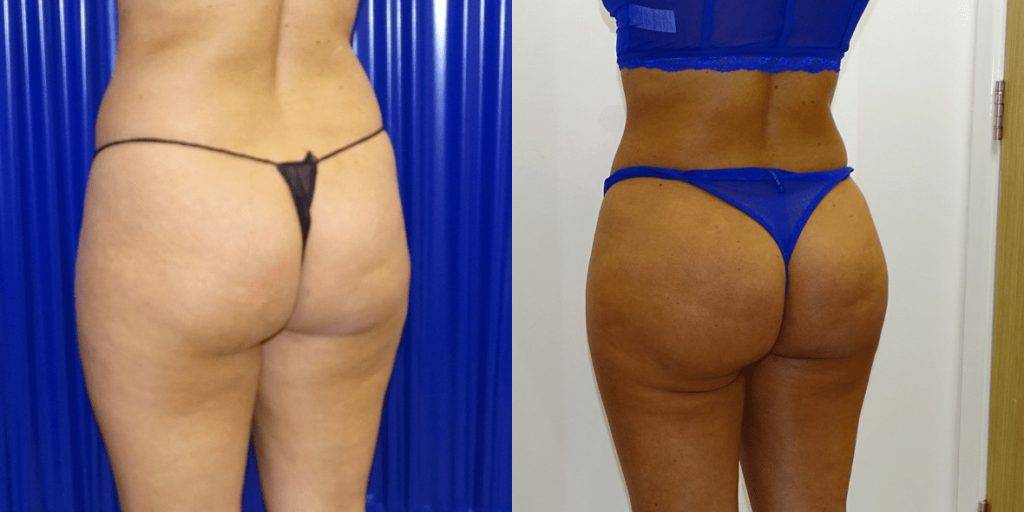 Brazilian Butt Lift Before/ After