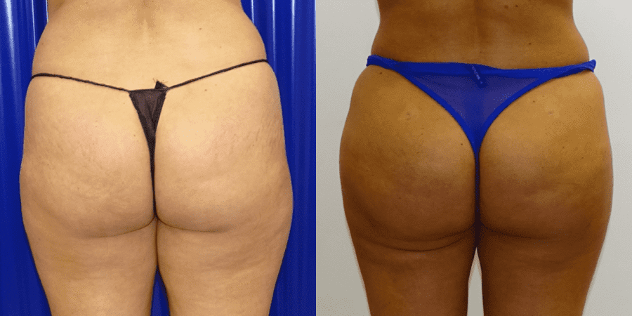 Brazilian Butt Lift Before/ After - Close-Up