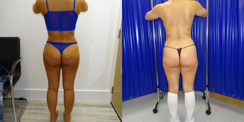 The before and after of a woman's butt lift surgery.