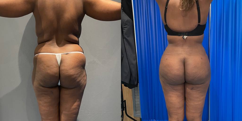 Plastic Surgery For Skinny Legs (And A Big Butt)
