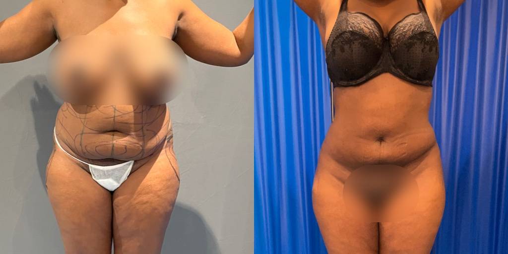 Plastic Surgery For An Hourglass Figure