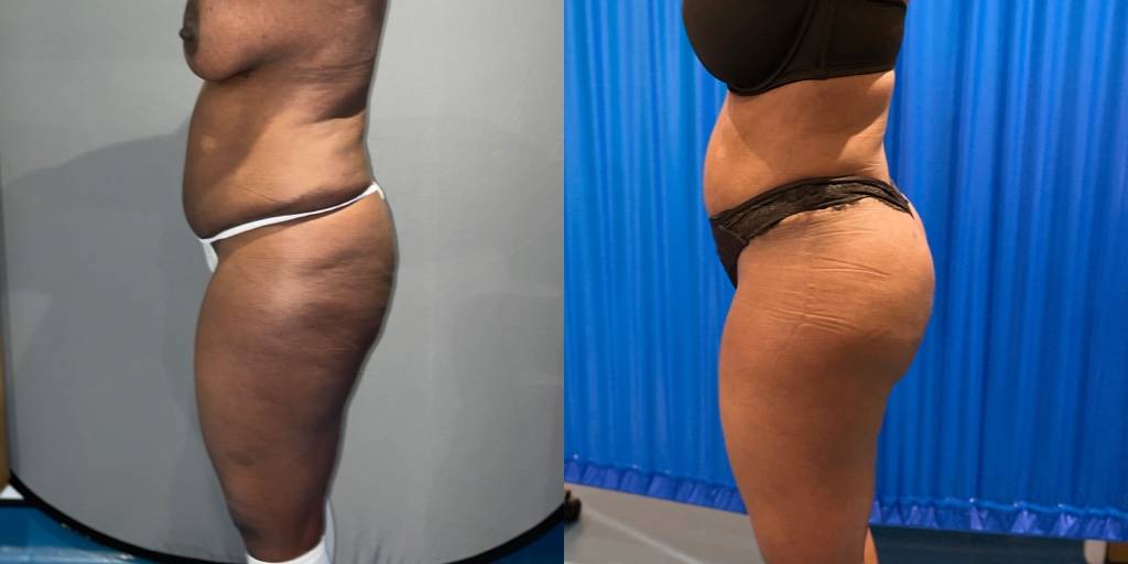Brazilian Butt Lift Before And After Side View