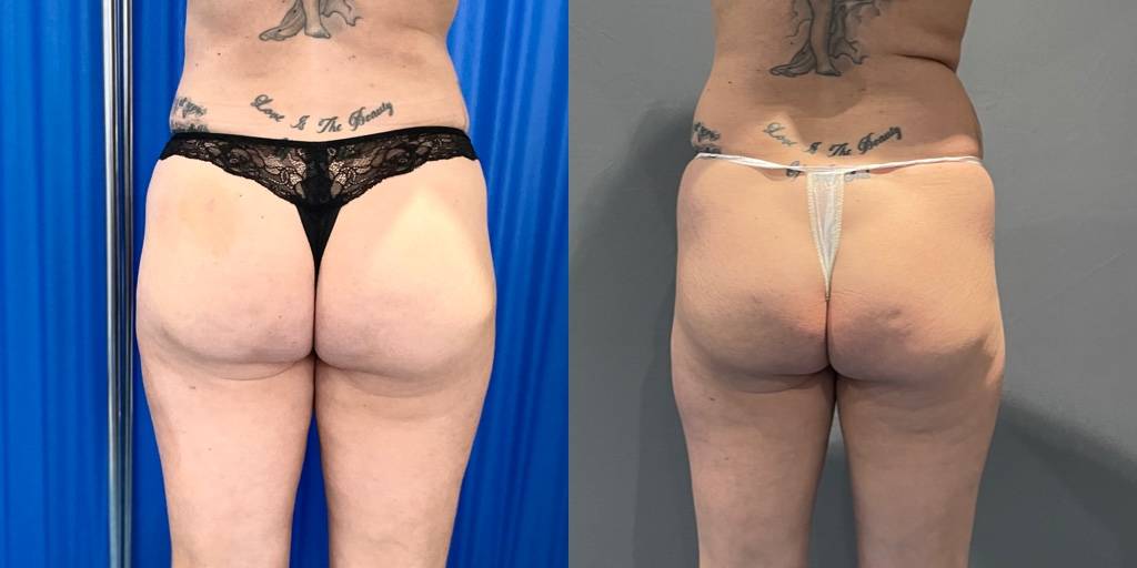 A woman's butt after butt lift surgery.