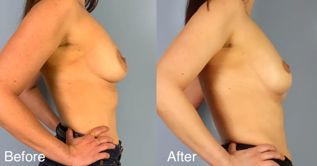 A Patient Before And After Areola Reduction