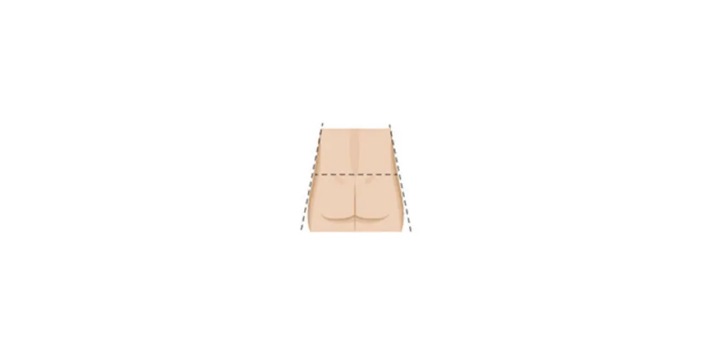 Learn more about your butt shape and the shape BBL can give you from CREO Clinic in London. Bbl Shapes