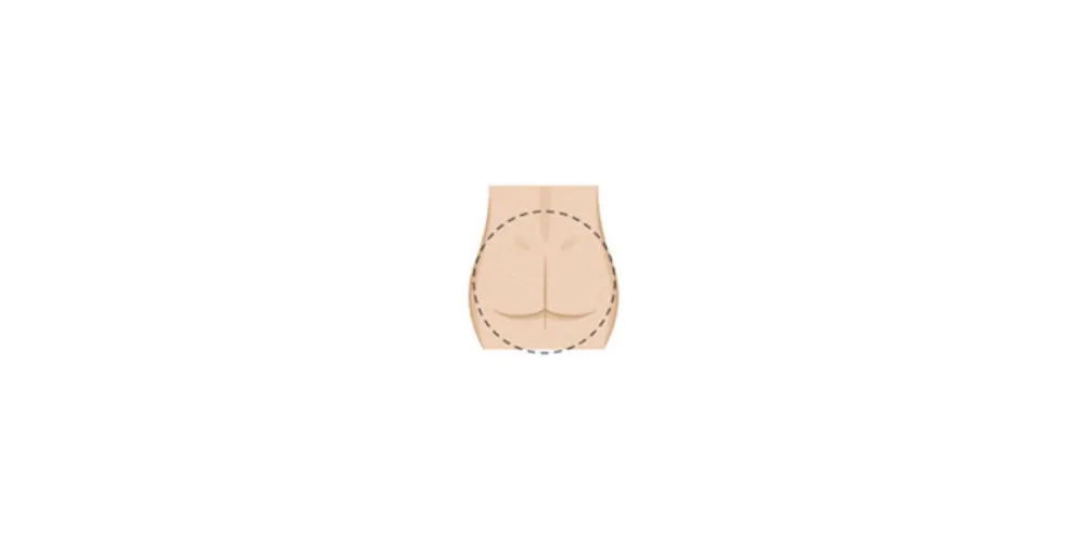 Learn more about your butt shape and the shape BBL can give you from CREO Clinic in London. Bbl Shapes