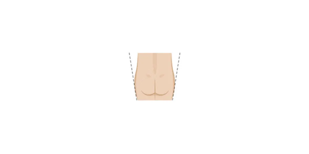 Learn more about your butt shape and the shape BBL can give you from CREO Clinic in London. Bbl Shapes