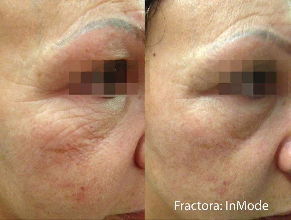 Morpheus8 Vs Ultherapy