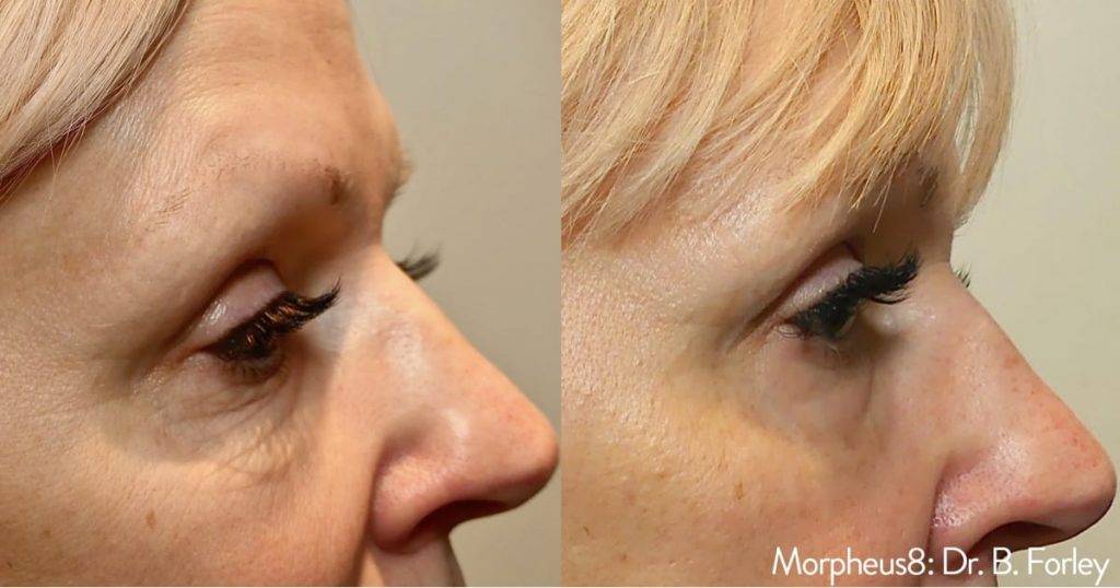 Before and after Morpheus8 treatment