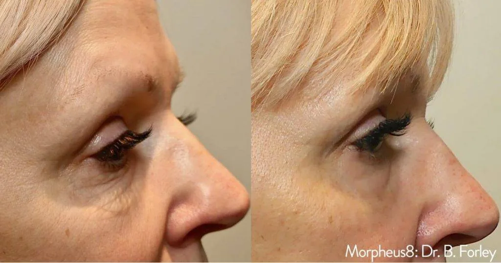 Morpheus8 Vs Ultherapy