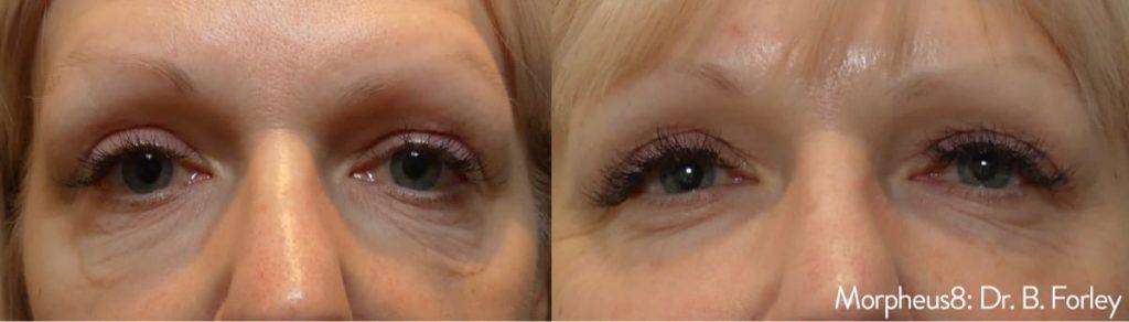 Before and after Morpheus8 treatment