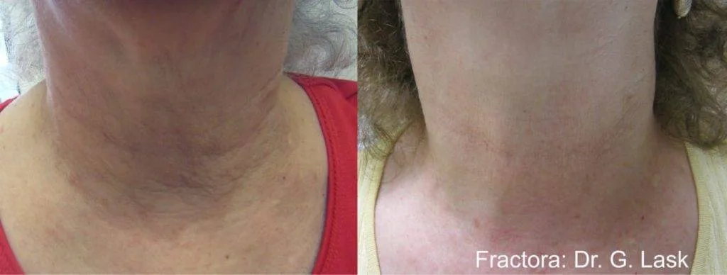 Morpheus8 Vs Ultherapy