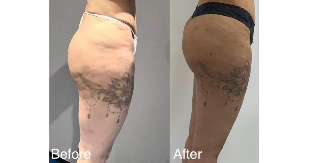Thigh Lift Reduction Surgery London