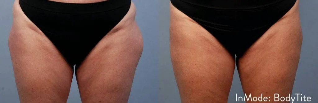 Do you want to get rid of your saddlebags permanently? Read more about how to lose outer thigh fat. How To Get Rid Of Saddlebags Without Exercise
