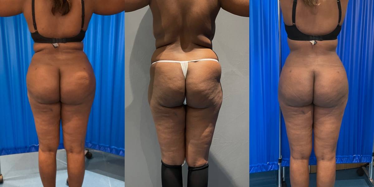 Butt Implant Removal