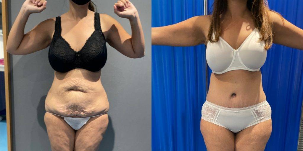 Before And After Of A Patient'S Tummy Tuck.