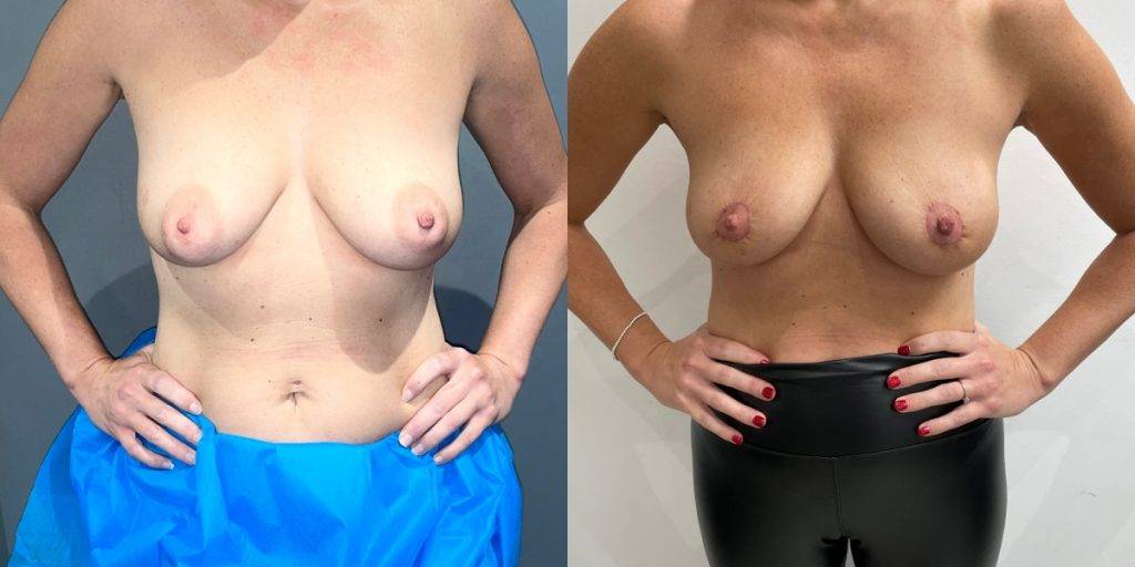 Areola Reduction B&A