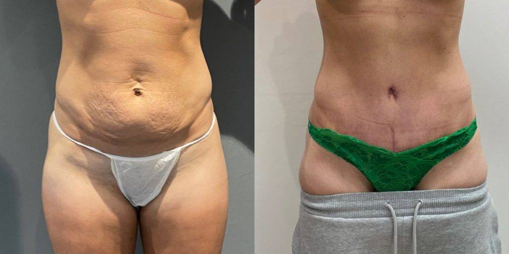 Before And After Abdominoplasty