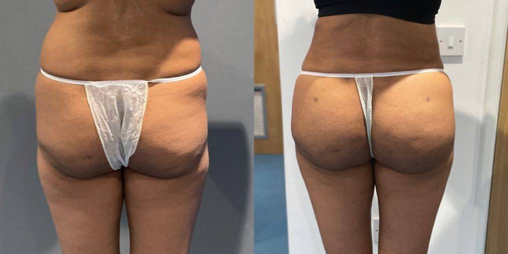 Before and after brazilian butt lift