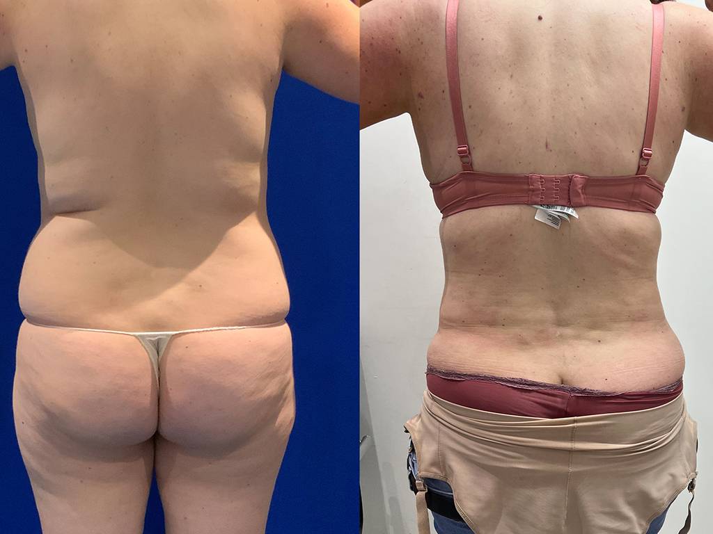 360 Liposuction Before/ After - Back