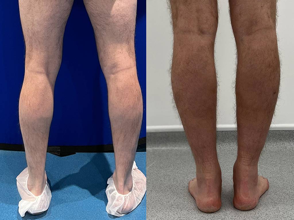 Fat Transfer to Calves Before/ After - Back
