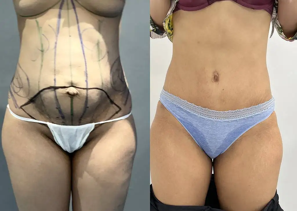 Abdominoplasty 2 Front 05/08