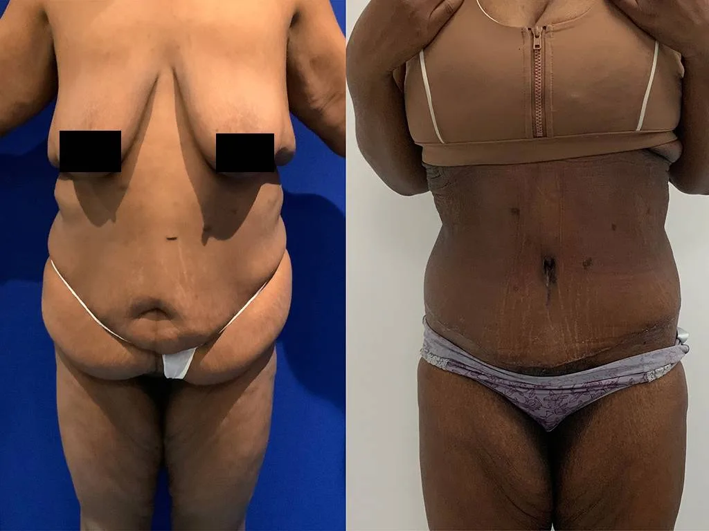 Abdominoplasty Before/ After - Front