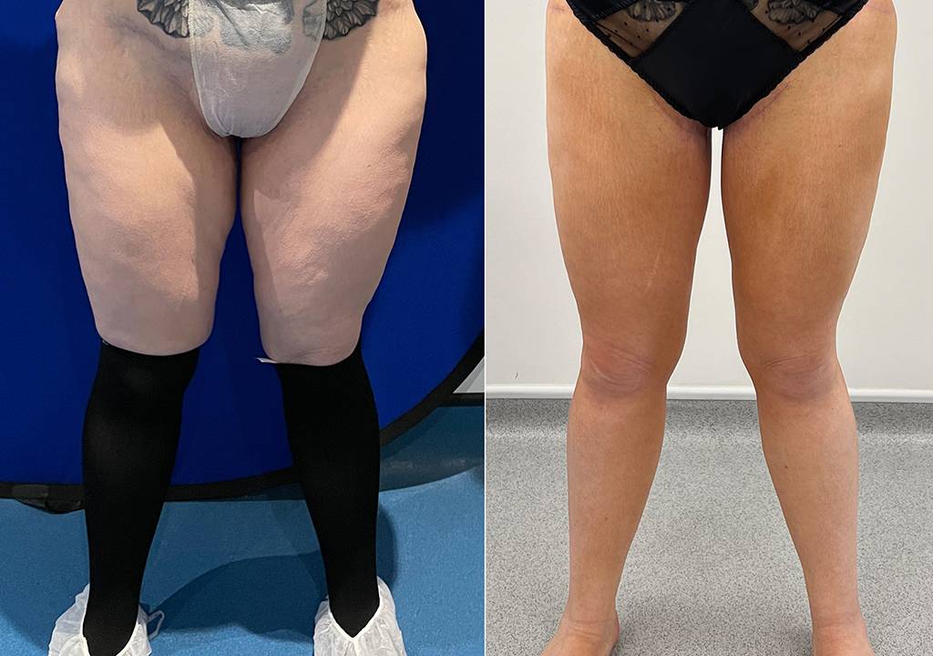 Thigh Lift Before/ After - Front