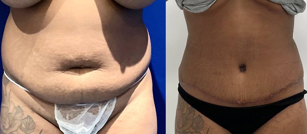 Lipoabdominoplasty Before/ After - Front