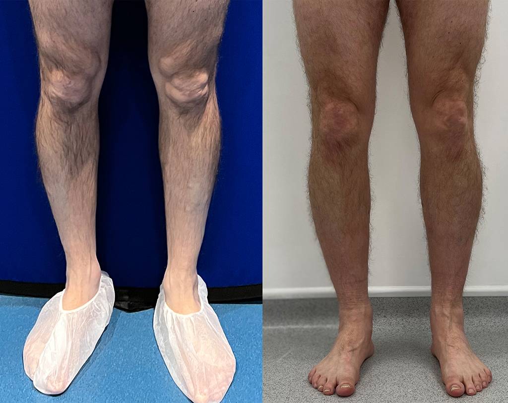 Fat Transfer to Calves Before/ After - Front