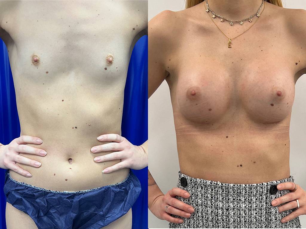 Breast Augmentation Before/ After - Front