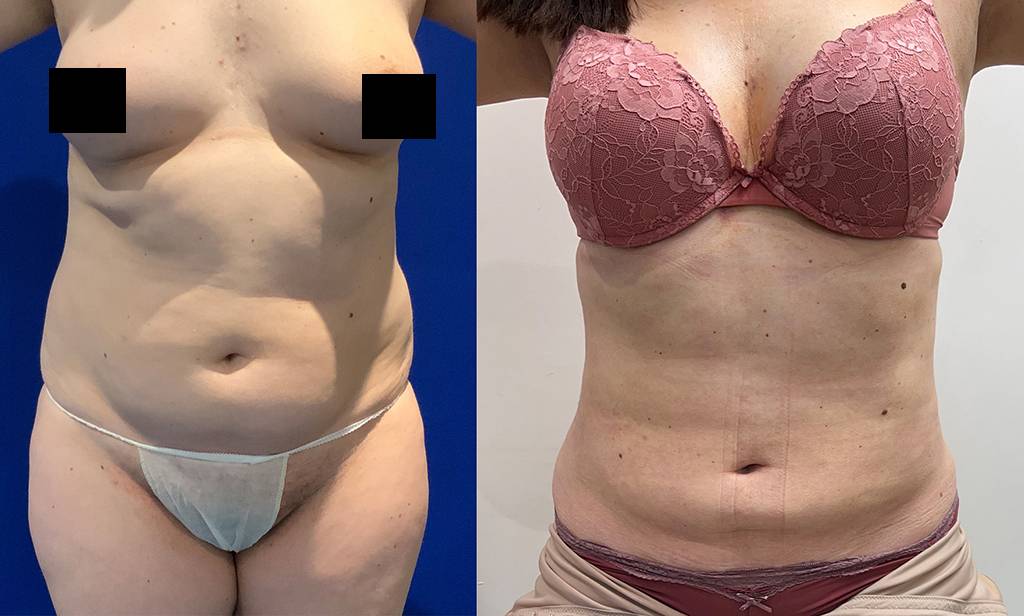 360 Liposuction Before/ After - Front