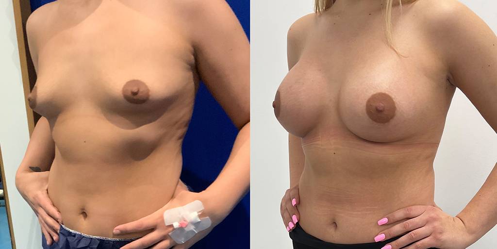 Breast Augmentation Before/ After - Quarter