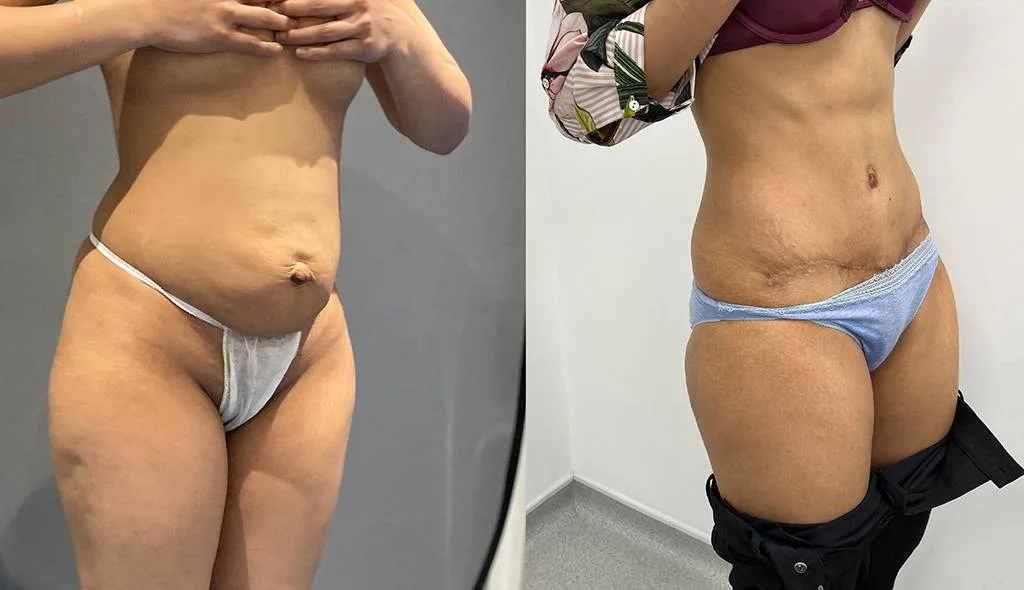 Abdominoplasty 2 Quarter 05/08