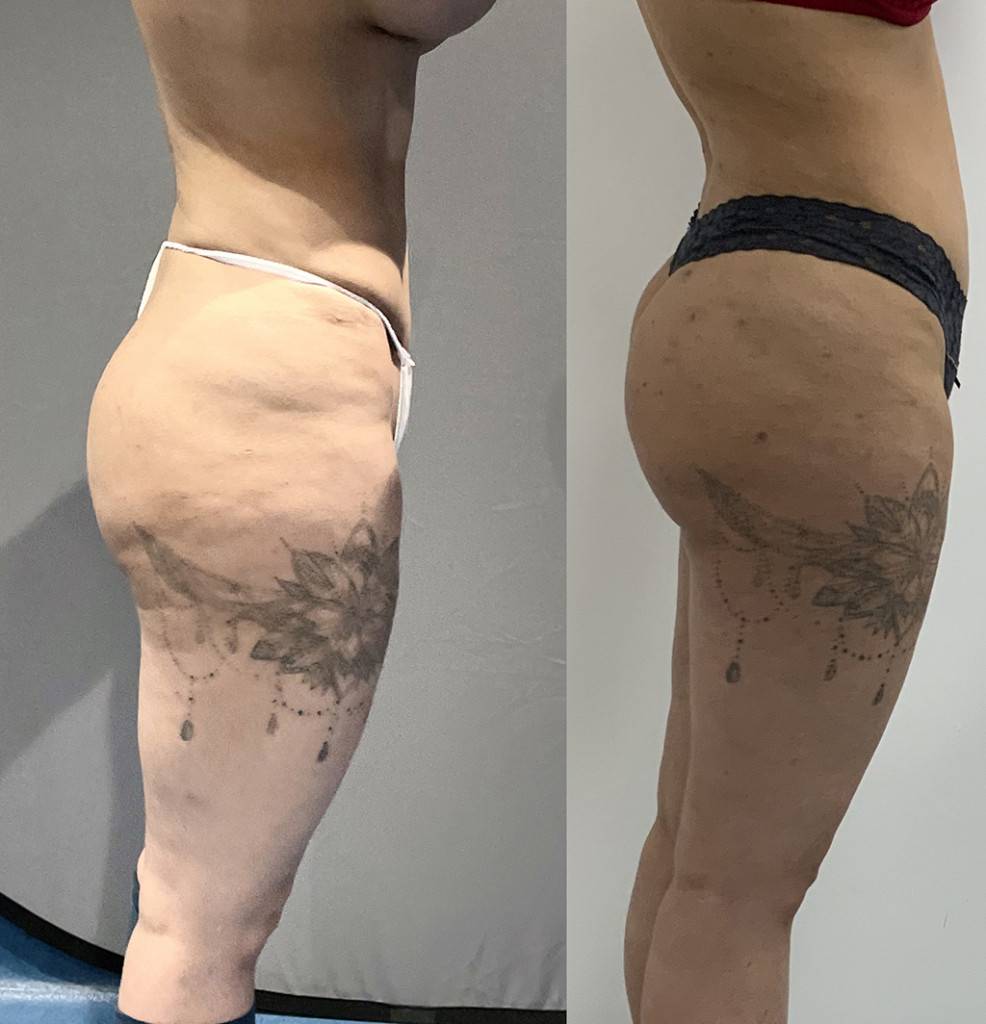 Thigh Lift Before/ After - Side