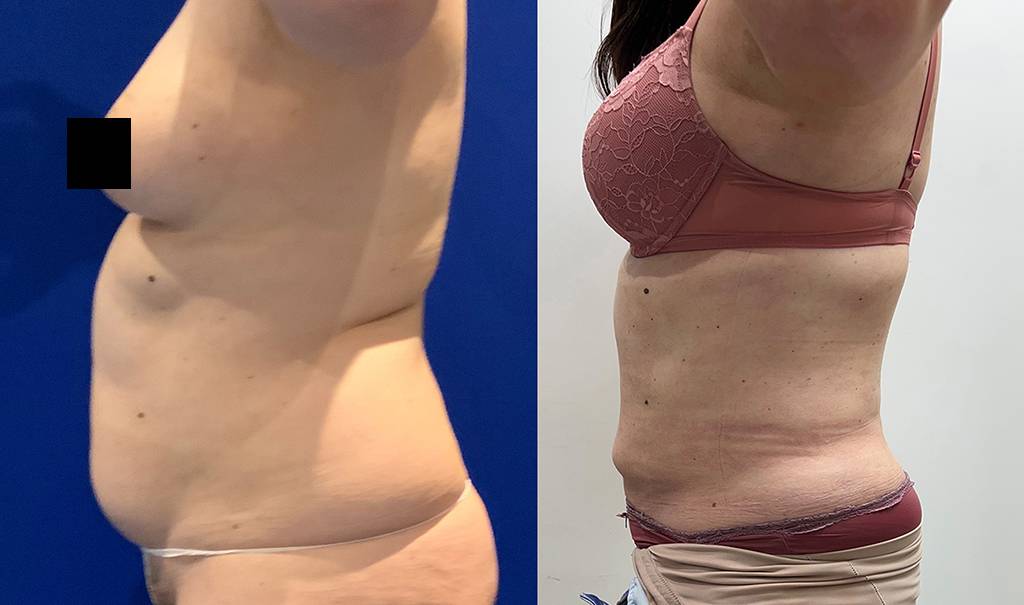 360 Liposuction Before/ After - Side