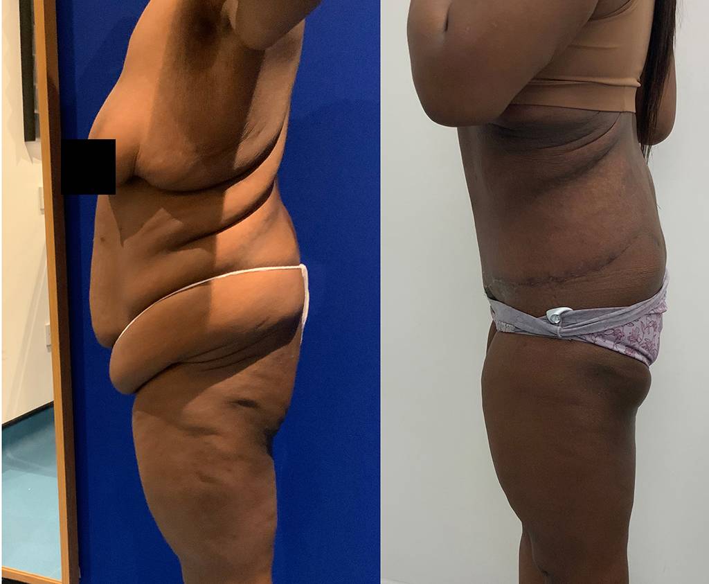 Abdominoplasty Before/ After - Side