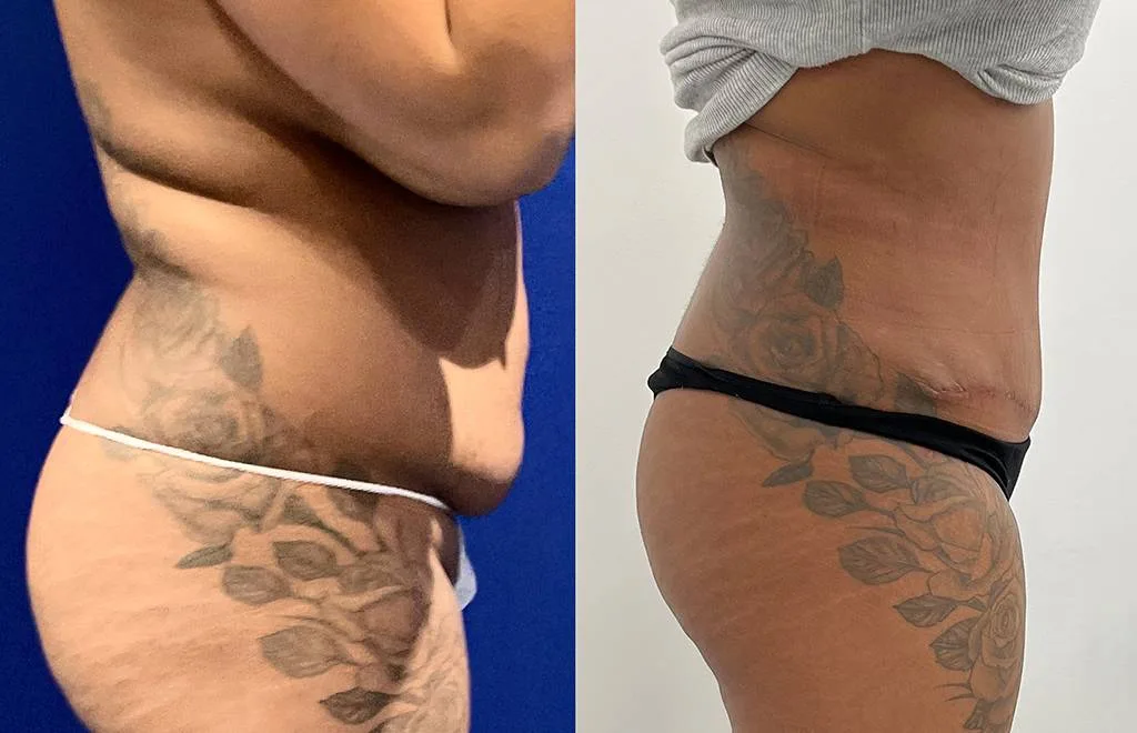 Lipoabdominoplasty Before/ After - Side