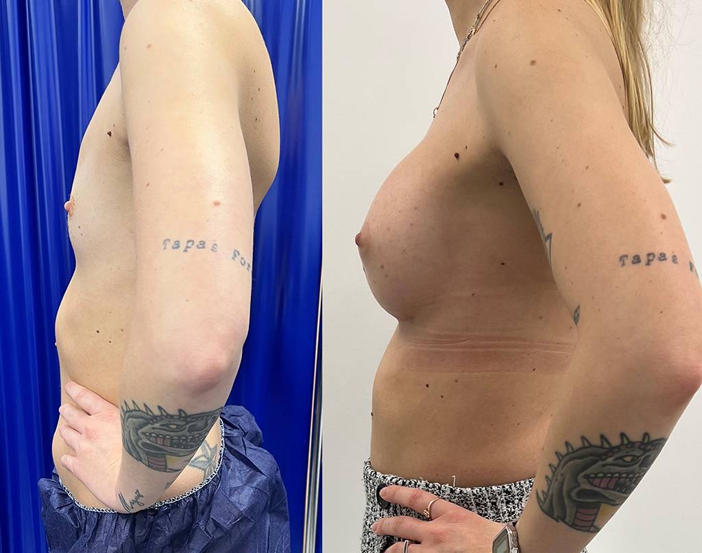 Breast Augmentation Before/ After - Side