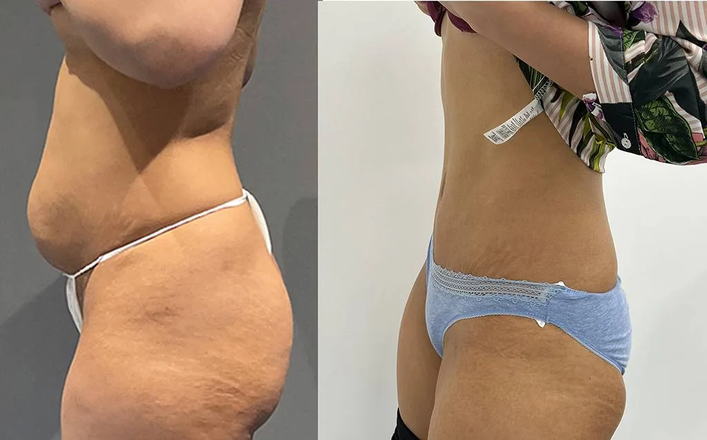 Abdominoplasty 2 Side 05/08